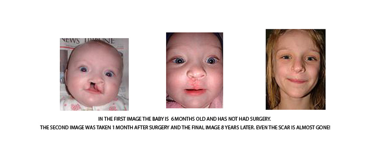 cleftsurgery